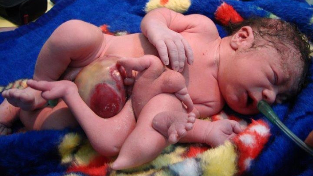 Baby with Seven Legs Found in a Dumpster