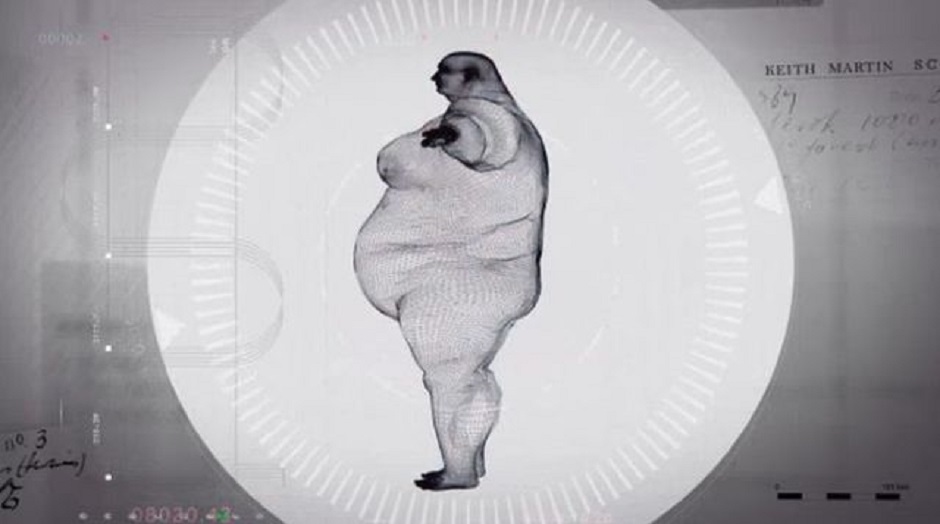 The X-Rays of a 900 Pounds British Man