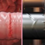 Scientists Have Developed New Surgical Gummy Tape to replace Sutures